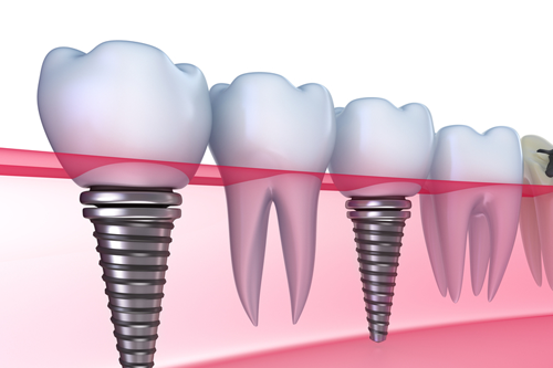 מרפאת שיניים של דוקטור אורי זילברמן רופא שיניים מומחה בשיטת ALL ON 4